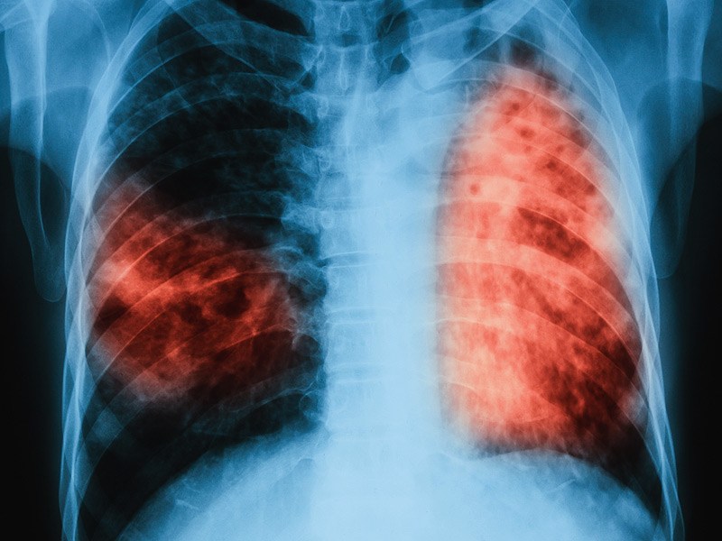 TB remains prevalent in Western Visayas