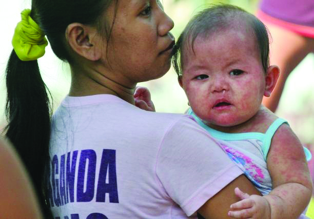 Measles is a highly contagious viral disease, according to the World Health Organization. It remains a common cause of death among young children globally despite the availability of a safe and effective vaccine. MAKABAYAN.PH