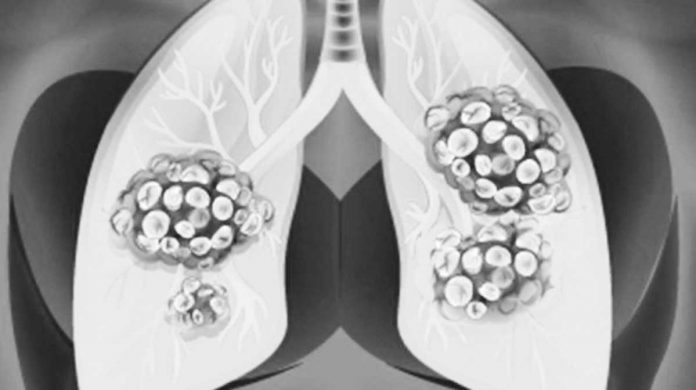 Oral health and lung cancer