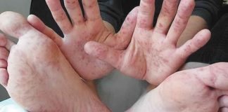 Hand-foot-and-mouth disease is a common infectious disease that occurs most often in children. In most cases, the symptoms are painful sores in the mouth, fever, and a rash with blisters on the feet, hands, and buttocks.