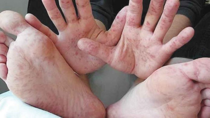 Hand-foot-and-mouth disease is a common infectious disease that occurs most often in children. In most cases, the symptoms are painful sores in the mouth, fever, and a rash with blisters on the feet, hands, and buttocks.