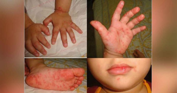 While hand-foot-mouth-disease is contagious, it is self-limiting or can be cured in seven to 10 days. A case can only be considered serious if it has secondary infection which very rarely happens and Region 6 has not recorded any yet, according to the Department of Health.