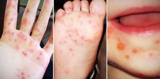 Hand Foot and Mouth Disease is a viral infection common in children under 10 years old. It is characterized by fluid-filled blisters appearing on the hands, feet and mouth with or without fever.