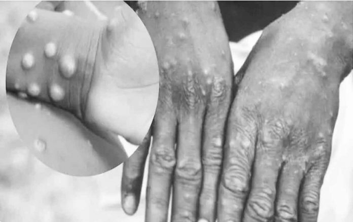 Monkeypox is a rare disease caused by infection with the monkeypox virus. Symptoms are similar to smallpox symptoms, but milder – rash with blisters on face, hands, feet, body, eyes, mouth or genitals; fever; swollen lymph nodes; headaches; muscle and back aches; and low energy.