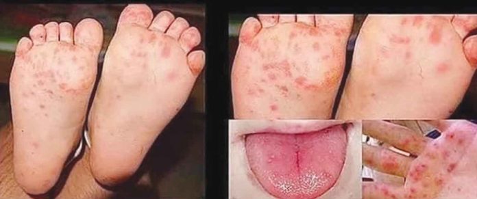 Hand-foot-mouth disease is a highly contagious disease common to children with symptoms including painful sores in the mouth, rash and blisters on feet, hands and buttocks and fever. It is spread from an infected person to others through close personal contact, and through the air when an infected person coughs or sneezes.