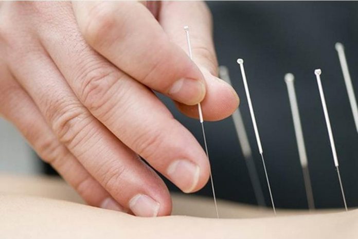 Acupuncture is a form of alternative medicine and a component of traditional Chinese medicine in which thin needles are inserted into the body. Stock image from Agence France-PresseAcupuncture is a form of alternative medicine and a component of traditional Chinese medicine in which thin needles are inserted into the body. Stock image from Agence France-Presse