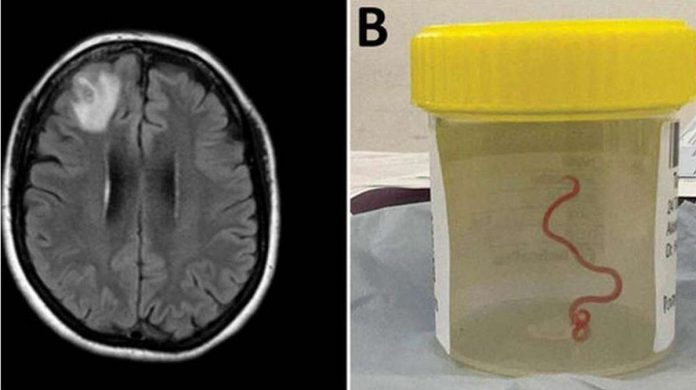 A brain scan and the parasite in a specimen jar. ANU