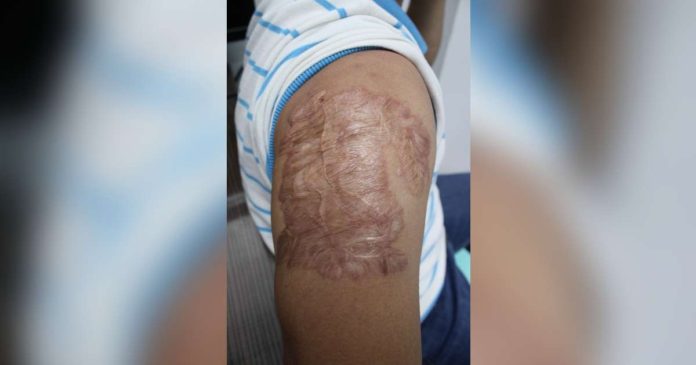 This Iloilo City Police Office policeman who asked that his identity be kept confidential shows to Panay News his previously tattooed arm. In 2010 or 14 years ago, he had the tattoo removed, and this is what remains. AJ PALCULLO/PN