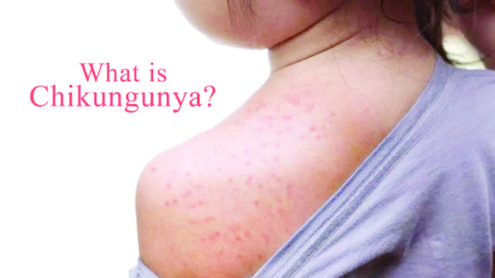 Chikungunya symptoms include fever, joint pain, joint swelling, rashes, headache, body aches, nausea, and fatigue.