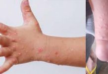 Blistering is one of the symptoms of hand, foot, and mouth disease (HFMD). Data from the Iloilo Provincial Health Office showed 723 cases were recorded in the province in 2024. PNA file photo