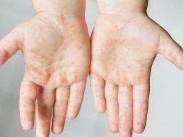 A child shows symptoms of hand, foot, and mouth disease in his hands. HFMD is a highly contagious viral disease that is common among children. The virus can be easily passed to other people through saliva droplets after an infected person sneezes, coughs, or talks. PIA