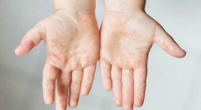 A child shows symptoms of hand, foot, and mouth disease in his hands. HFMD is a highly contagious viral disease that is common among children. The virus can be easily passed to other people through saliva droplets after an infected person sneezes, coughs, or talks. PIA